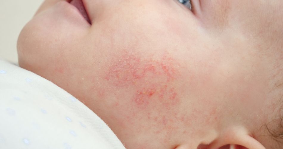 Dermatitis atópica: sus causas y tratamientos